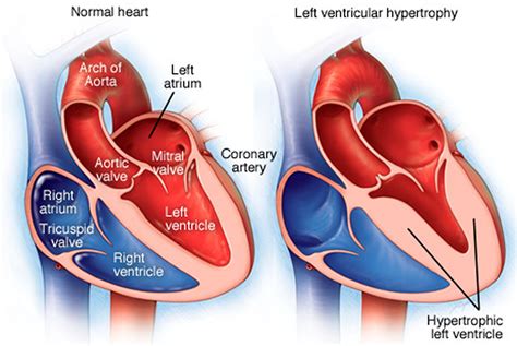 lv dilatation|mildly dilated left ventricle symptoms.